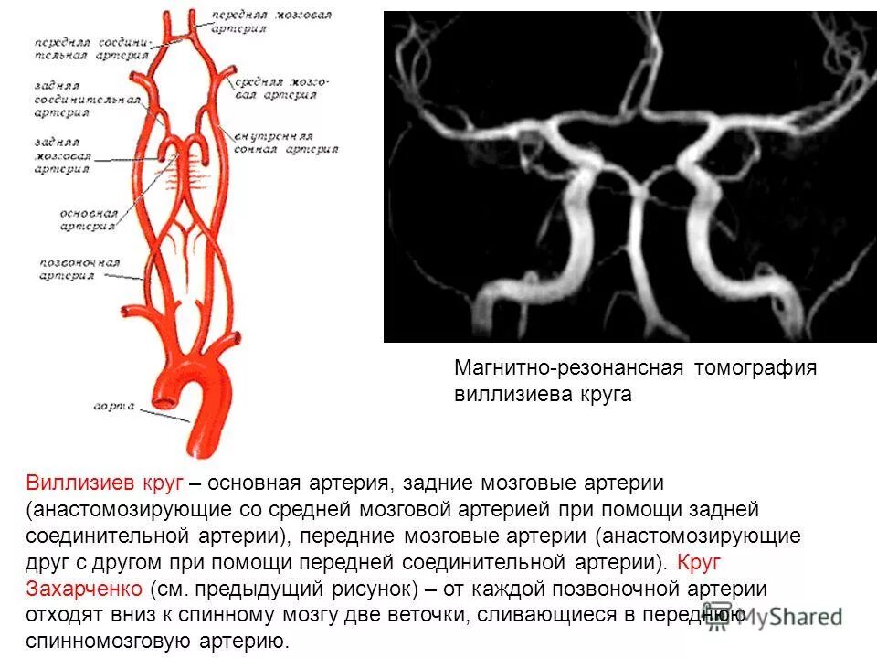 Развитие виллизиева круга в виде отсутствия кровотока. Артерии головного мозга Виллизиев круг схема. Основные сосуды артериального Виллизиева круга. Виллизиева круга головного мозга. Сосуды виллизиевого круга мрт.
