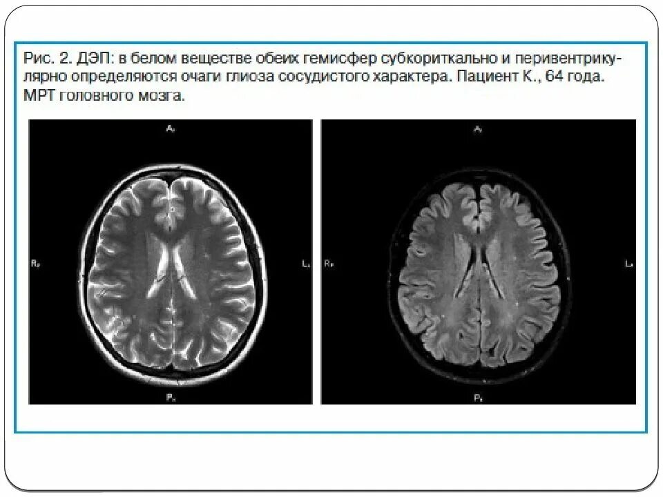 Дисциркуляторная энцефалопатия мрт. Гипертензивная энцефалопатия мрт головного мозга. Дисциркуляторная энцефалопатия на кт. Энцефалопатия головного мозга на мрт. Глиоз полушарий мозга