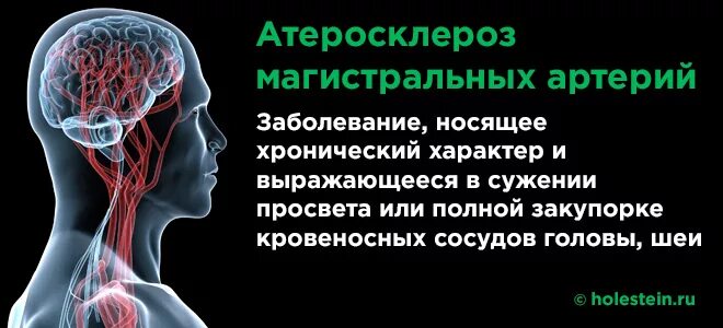 Атеросклероз магистральных артерий. Атеросклероз магистральных артерий головы. Атеросклеротическое поражение магистральных артерий головы. Магистральные сосуды головы. Симптомы проблем с сосудами головного