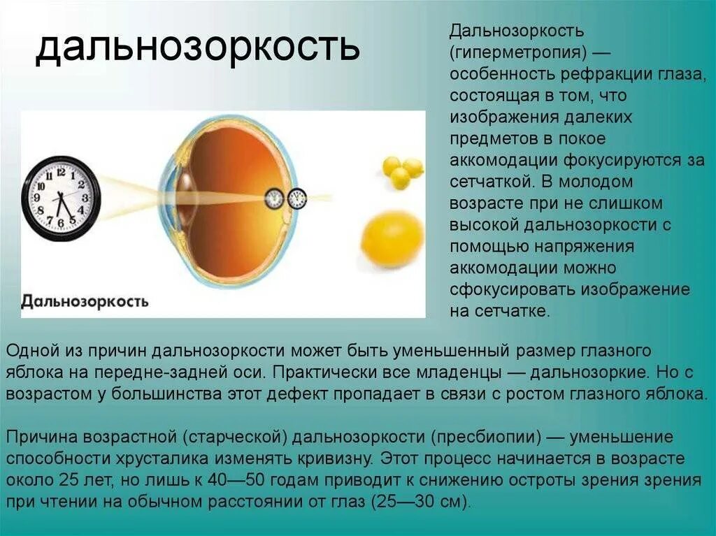 Почему возникает дальнозоркость. Миопия дальнозоркость астигматизм. дальнозоркость (гиперметропия). близорукость и дальнозоркость глазное яблоко. зрение при близорукости.