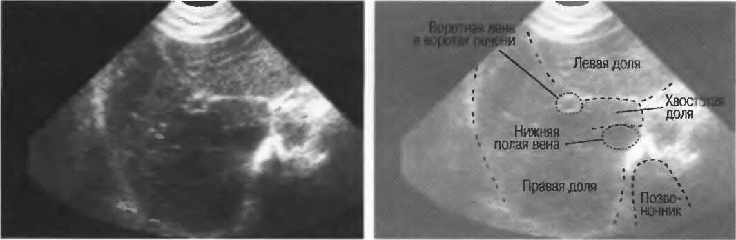 Причины увеличения доли печени. УЗИ печени гепатомегалия. Гепатоспленомегалия на УЗИ.