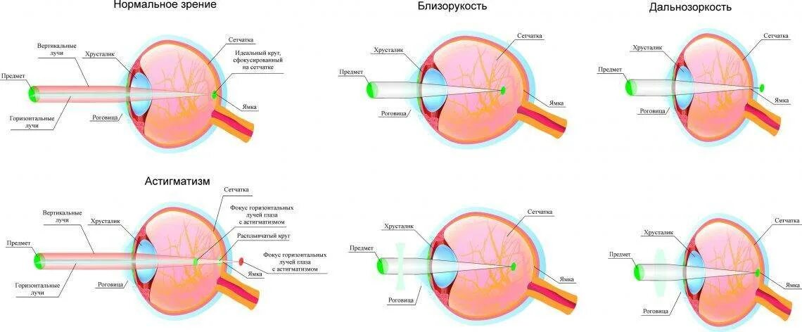 Точка лежащая зрение. Аномалии рефракции глаза (близорукость, дальнозоркость, астигматизм). Близорукость дальнозоркость астигматизм нормальное зрение. Гиперметропия 1 степени миопический астигматизм. Аномалии рефракции миопия гиперметропия астигматизм.