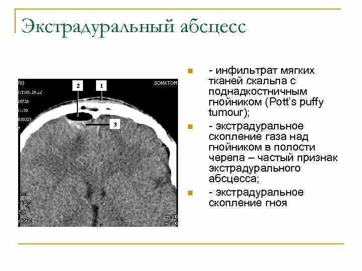 Абсцесс мягких тканей как выглядит Абсцесс: симптомы, причины и лечение