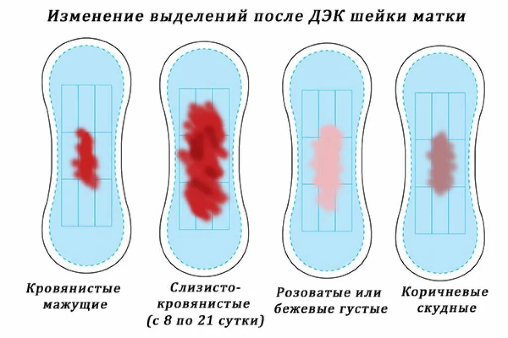 Забеременела от смазки выделений. Выделения после прижигания. Нормальные и обильные месячные. Выделения после менструации. Струп после прижигания эрозии.