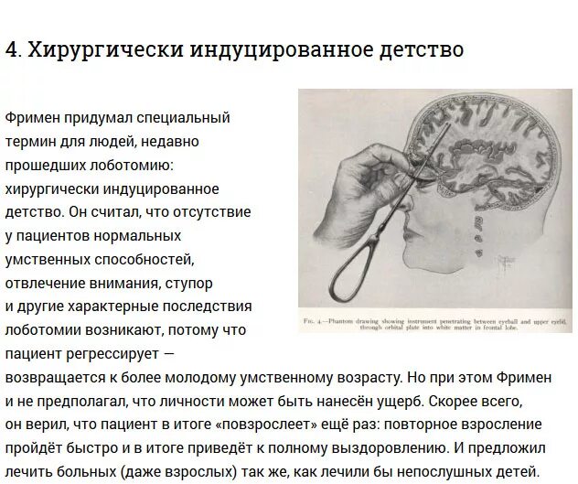 Лоботомия для чего нужна. Трансорбитальная Лоботомия. Транс орбитальная Лоботомия.