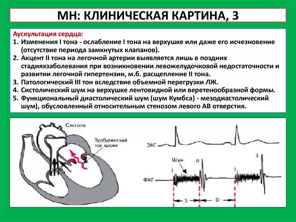 Сердечные тоны шумы. Акцент 2 тона систолический шум на верхушке. Аускультация сердца акцент 2 тона. Ослабление 1 тона на верхушке сердца систолический шум. Аортальный систолический шум.