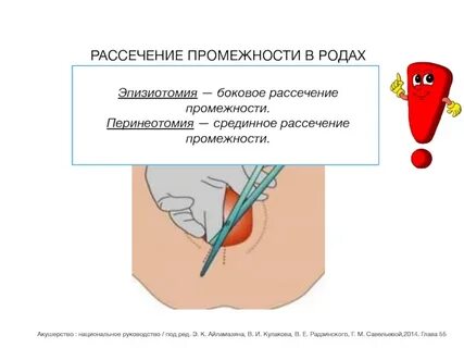 Швы при родах