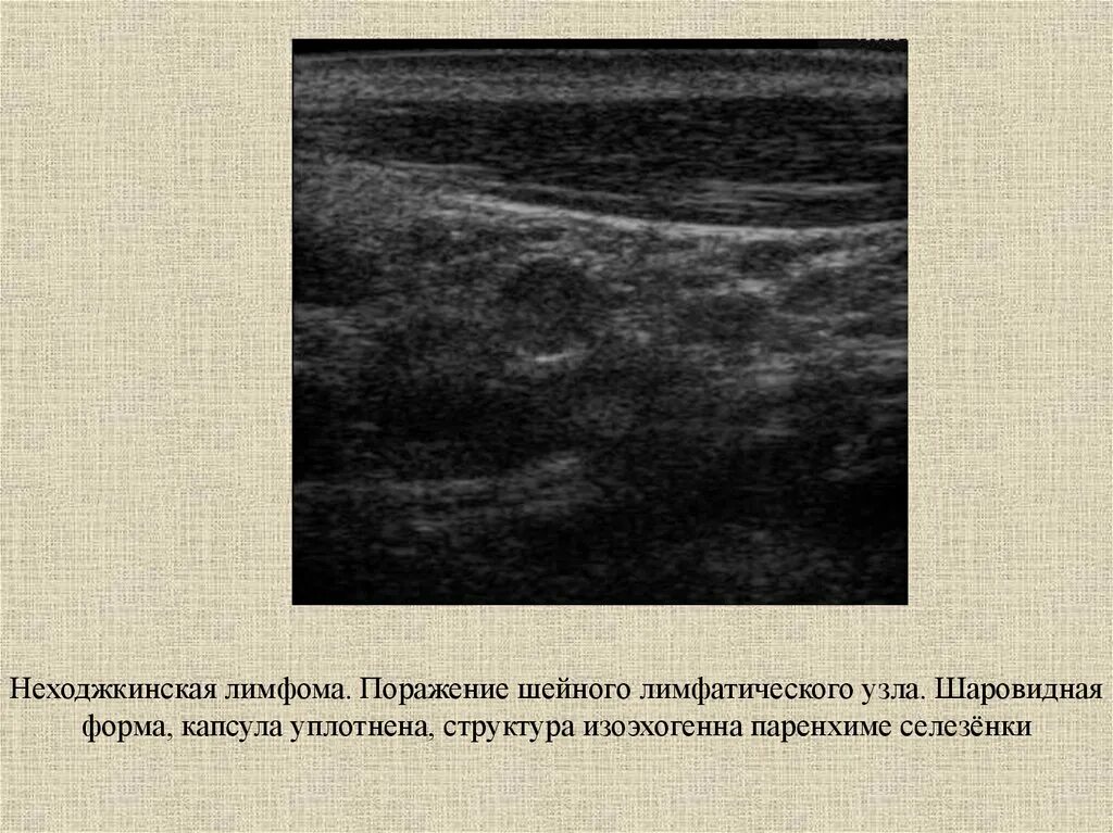 Лимфома лимфатические узлы. Лимфогранулематоз УЗИ лимфоузлов. Лимфатические узлы при лимфоме на УЗИ. Лимфогранулематоз селезенки УЗИ. УЗИ лимфоузлов при лимфоме Ходжкина.