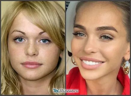 Хилькевич до пластики