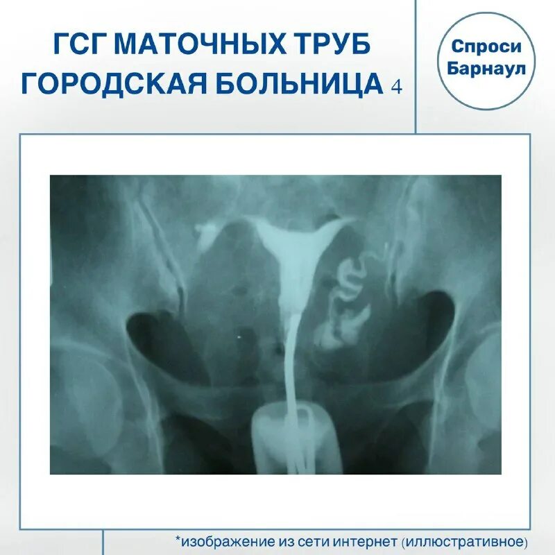 мсг непроходимость маточных. гсг маточных труб спб. гсг снимок маточных труб рентген. гсг маточных труб спб. гистеросальпингография эмбрион.