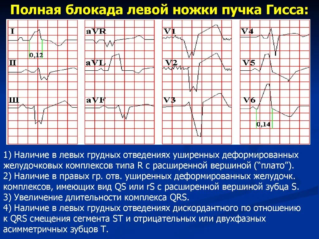 Признаки неполной блокады. ЭКГ при полной блокаде левой ножки пучка Гиса. ЭКГ полная блокада левой ножки пучка. ЭКГ признаки блокады левой ножки пучка. ЭКГ критерии блокады левой ножки пучка Гиса.