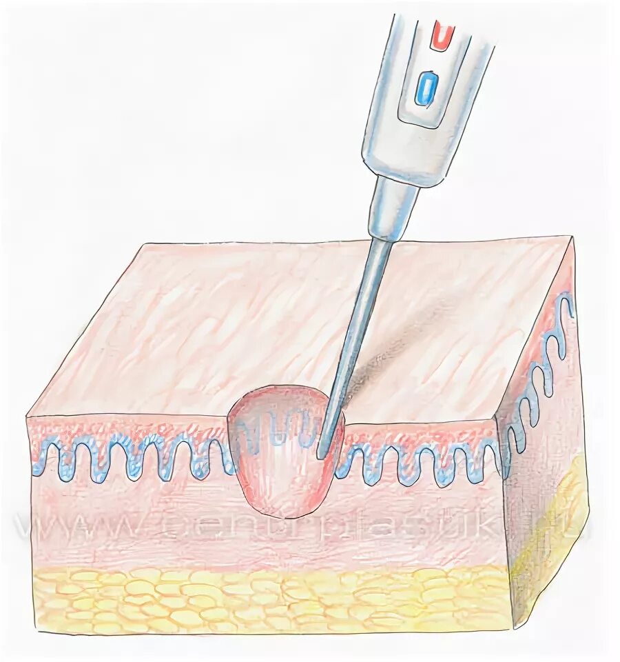 Кондиломы у женщин в интимной интимной зоне фото. Перианальных остроконечных кондилом. Остроконечные кондиломы впч. Радиоволновая деструкция папиллом. Лазерная деструкция кондилом.