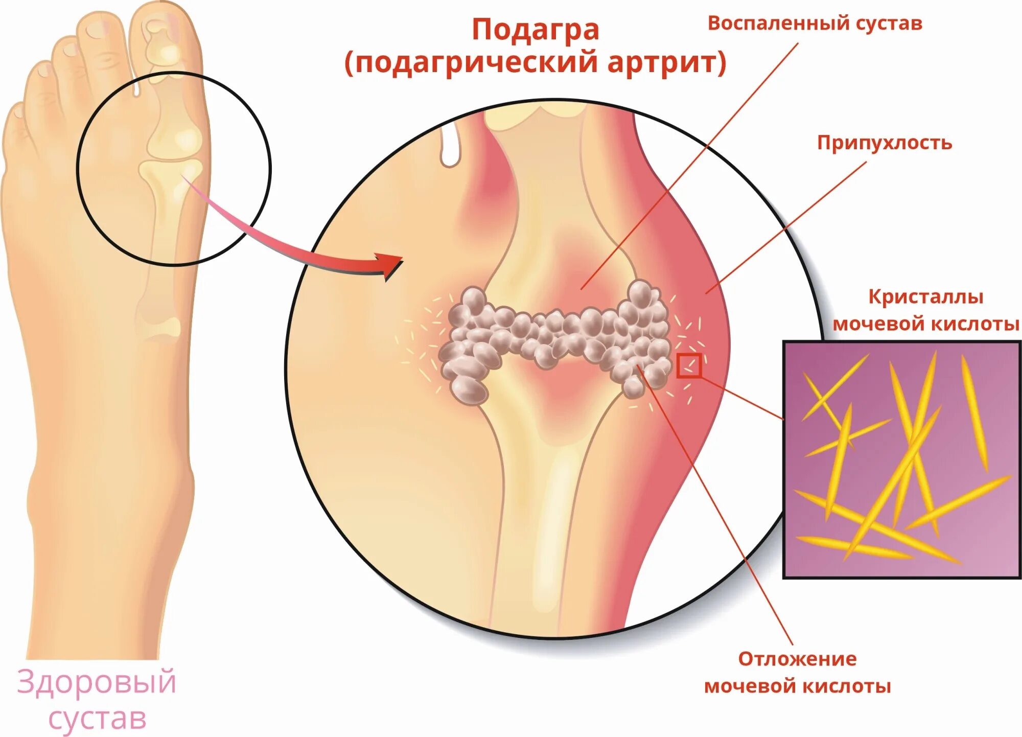Мочевая кислота повышена суставы. Отложение кристаллов мочевой кислоты в суставах. отложение солей мочевой кислоты в суставах. подагра мочевая кислота.