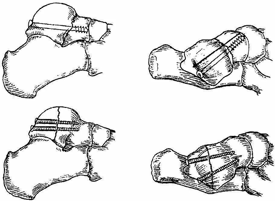 Операция пяточной кости. Таранная кость перелом. Операция на таранной кости при переломе. Остеосинтез при переломах таранной кости. Перелом отростка таранной кости.