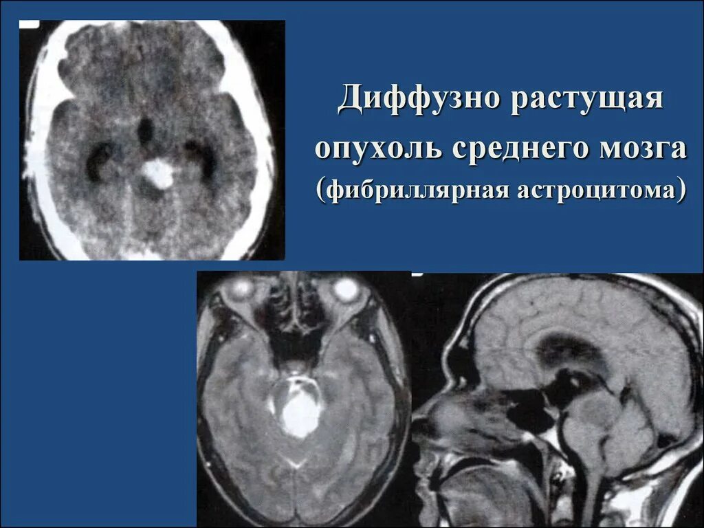 Диффузная глиома ствола мозга. Диффузная астроцитома мрт. Нарушения продолговатого мозга. Астроцитома головного мозга в стволе. Опухоли центральной нервной системы.