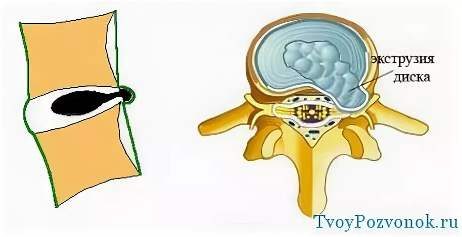 Экструзия диска l5-s1 что это такое. Экструзия диска с7 th1. Какие части межпозвонкового диска содержат воду. Как лечить экструзию диска. Как лечить экструзию диска.