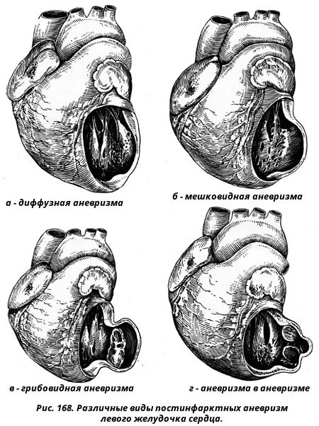 Мешковидная аневризма сердца. Постинфарктная аневризма левого желудочка. Постинфарктная аневризма сердца. Постинфарктная аневризма левого желудочка осложнения. Аневризма сердца что это такое симптомы