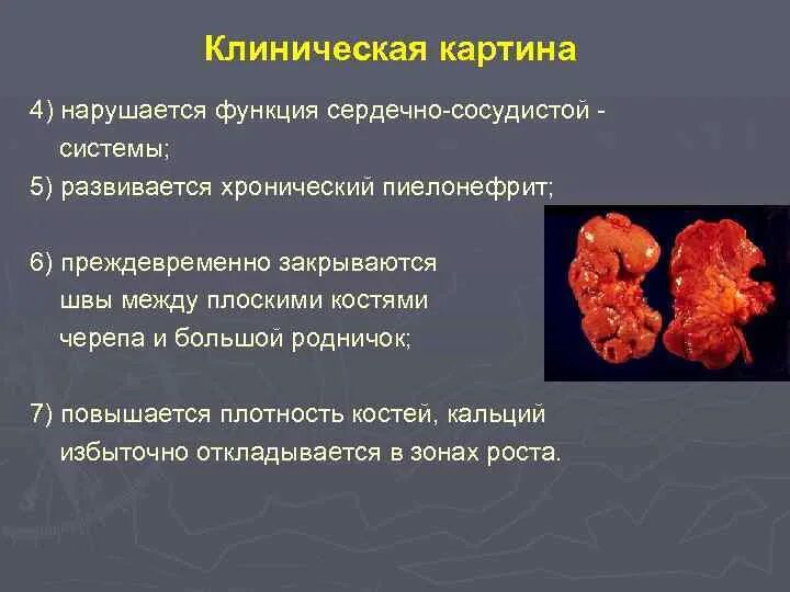 Белки при пиелонефрите. Изменения со стороны ССС при остром пиелонефрите. Пиелонефрит клиническая картина. Клиническая картина хронического пиелонефрита. При пиелонефрите нарушается функция:.