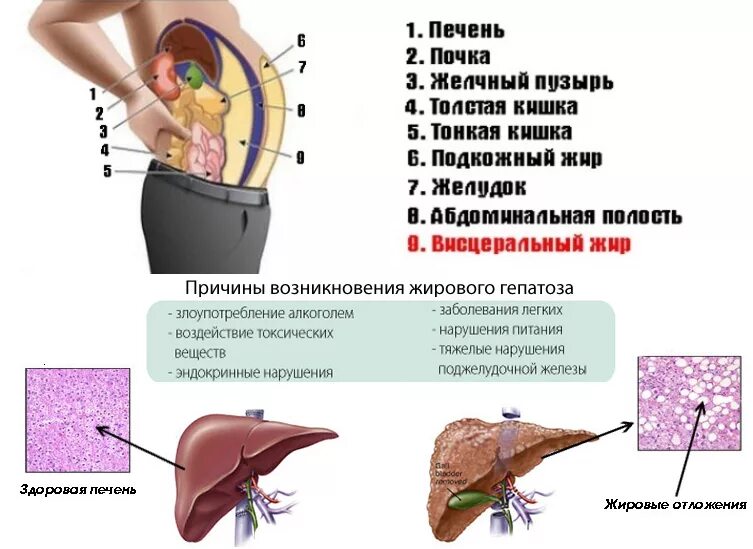 Убрать жировую печень. Жировой гепатоз печени симптомы. Гепатоз ожирение печени. Жировое Перерождение печени. Висцеральный жир на печени.