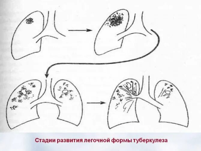 Фазы очагового туберкулеза