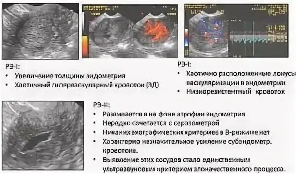 Эндометрия матки узи гиперплазия эндометрия. Полип матки по узи заключение. Что значит локусы кровотока. Что значит локусы кровотока. Фиброаденома щитовидной железы на узи.
