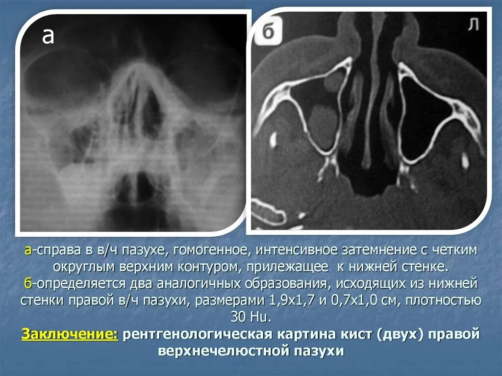 Пристеночный отек слизистой. Тотальное затемнение верхнечелюстной пазухи рентген. Септы верхнечелюстной пазухи. Киста лобной гайморовой пазухи. Стенки верхнечелюстной пазухи.