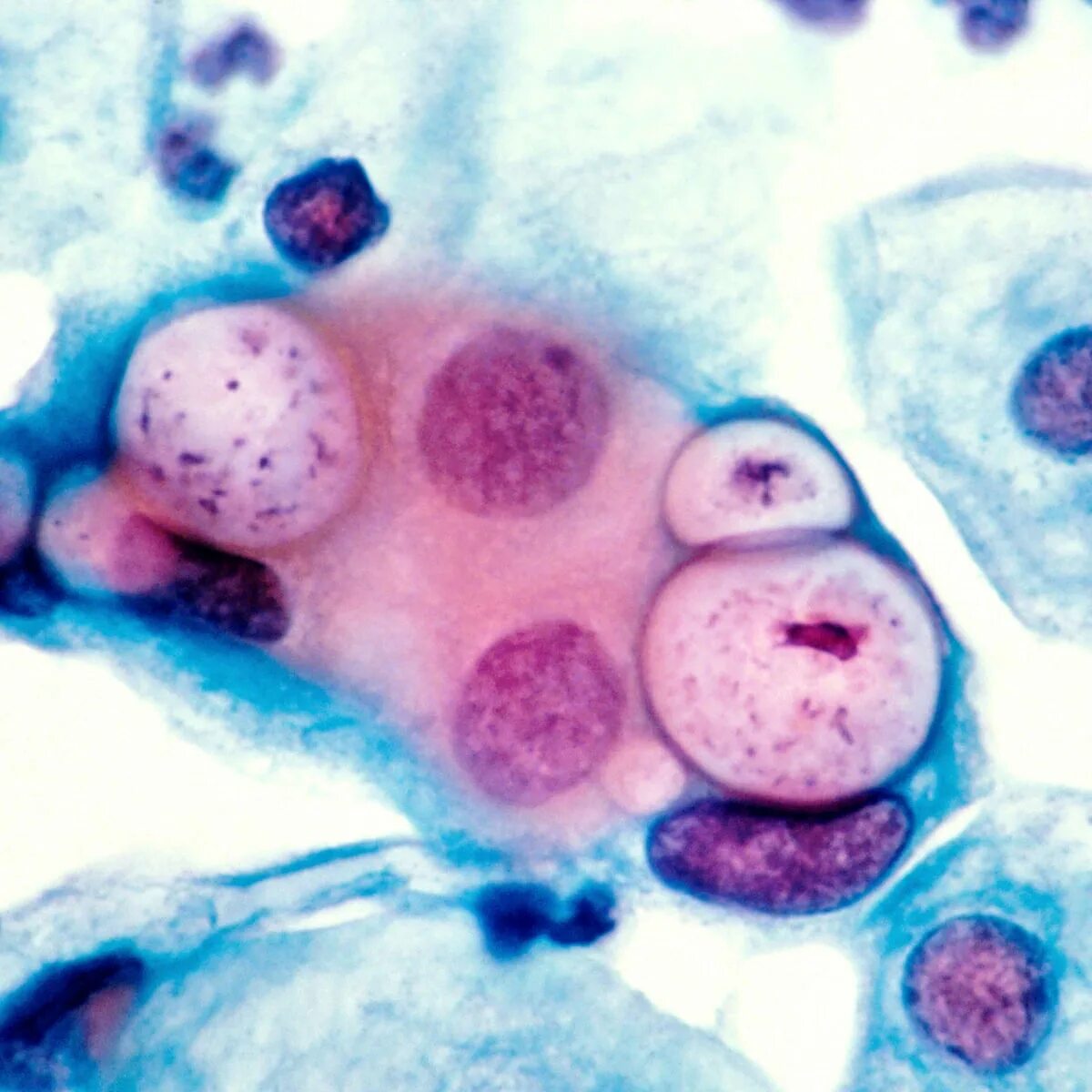 Anti chlamydia trachomatis. Хламидиями трахоматис.