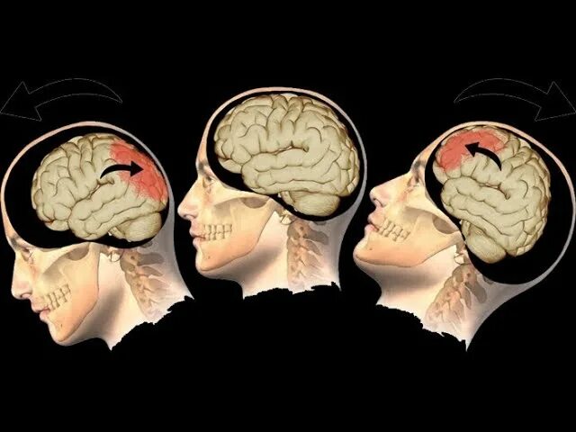 Тяжелые травмы головного мозга. ЧМТ ушиб головного мозга. Черепно-мозговая травма (ЧМТ) сотрясение головного мозга (СГМ). Ускорения-замедления ЧМТ. Черепно-мозговая травма рентген.