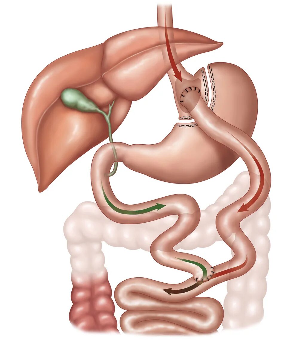 Бариатрия шунтирование желудка. Желудочного шунтирования Roux-en-y.. Бариатрическая операция шунтирование желудка. Бариатрическая хирургия Bypass. Бариатрическая хирургия это