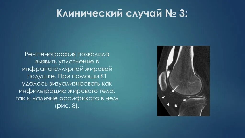 Отек гоффа коленного сустава. Отек жирового тела Гоффа. Жировая клетчатка Гоффа отек мрт. Жировое тело Гоффа мрт. Гипертрофия Гоффа коленного сустава.