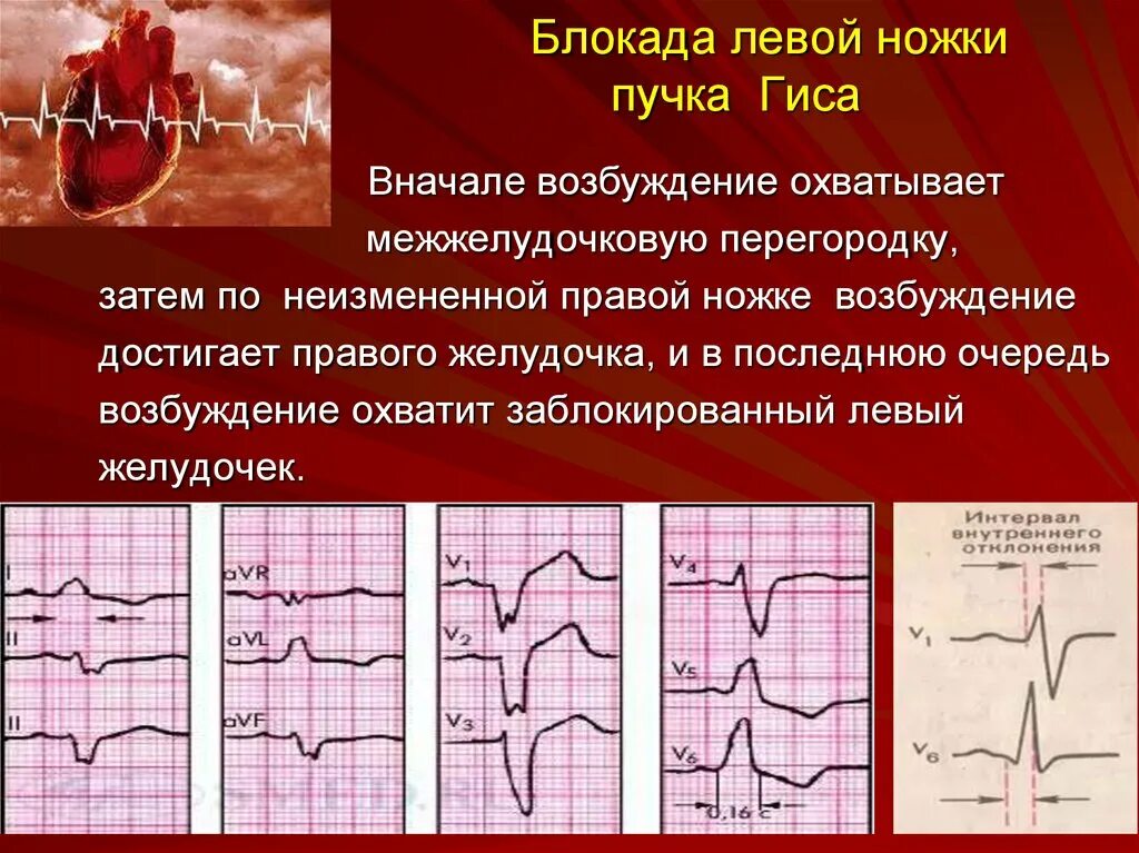 Разветвление верхней левой ножки пучка гиса. Блокада левойиножки пучка Гиса. Блокада левой ножки пучка ги а. Блокада левой ножки пучка Гиса. Блокада левой ножек пучка Гиса.