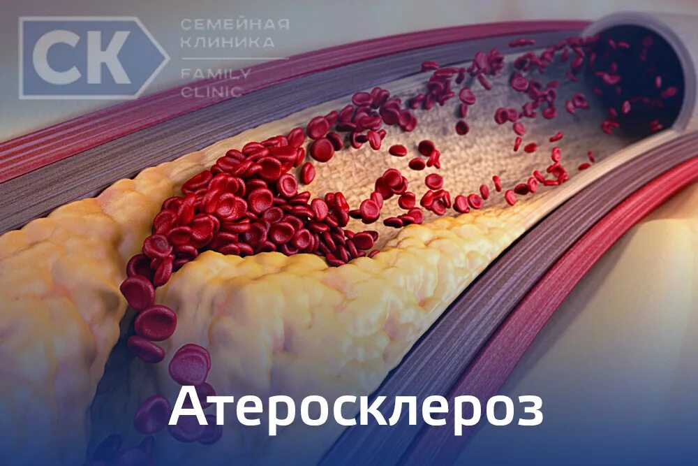 Атеросклеротическая болезнь сердца