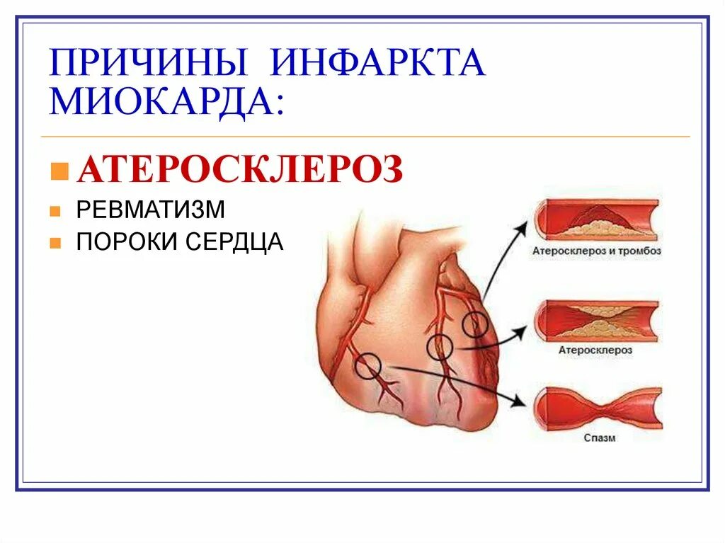 Инфаркт причины симптомы. Причины заболевания инфаркта миокарда. Бляшки инфаркт миокарда. Ишемическая болезнь сердца инфаркт миокарда. Инфаркт миокарда причигвм.