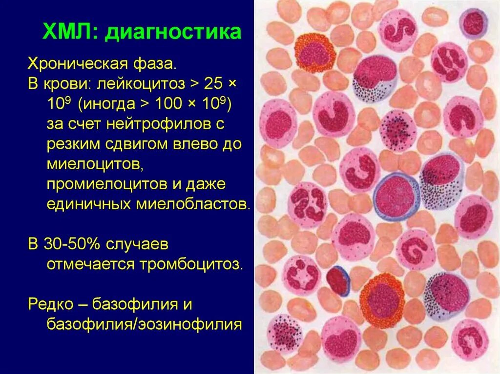 Базофилия и эозинофилия. Хронический миелолейкоз хроническая фаза. Картина крови при хроническом лимфолейкозе. Лимфолейкоз показатели