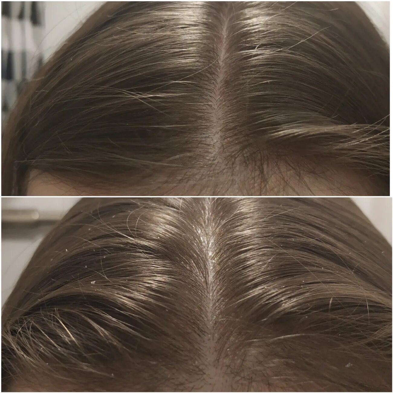Пилинг кожи головы фото до и после.
