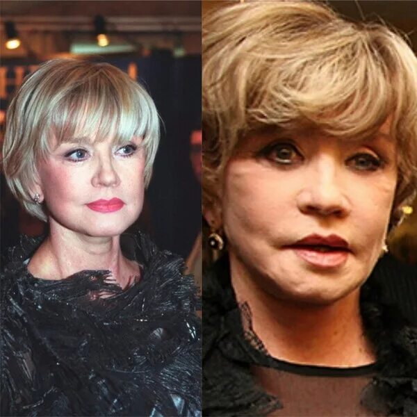 вера алентова после пластики 2022. пластика лица алентовой. алентова после неудачной пластики. вера алентова до пластики. вера алентова после пластической операции изуродовали.