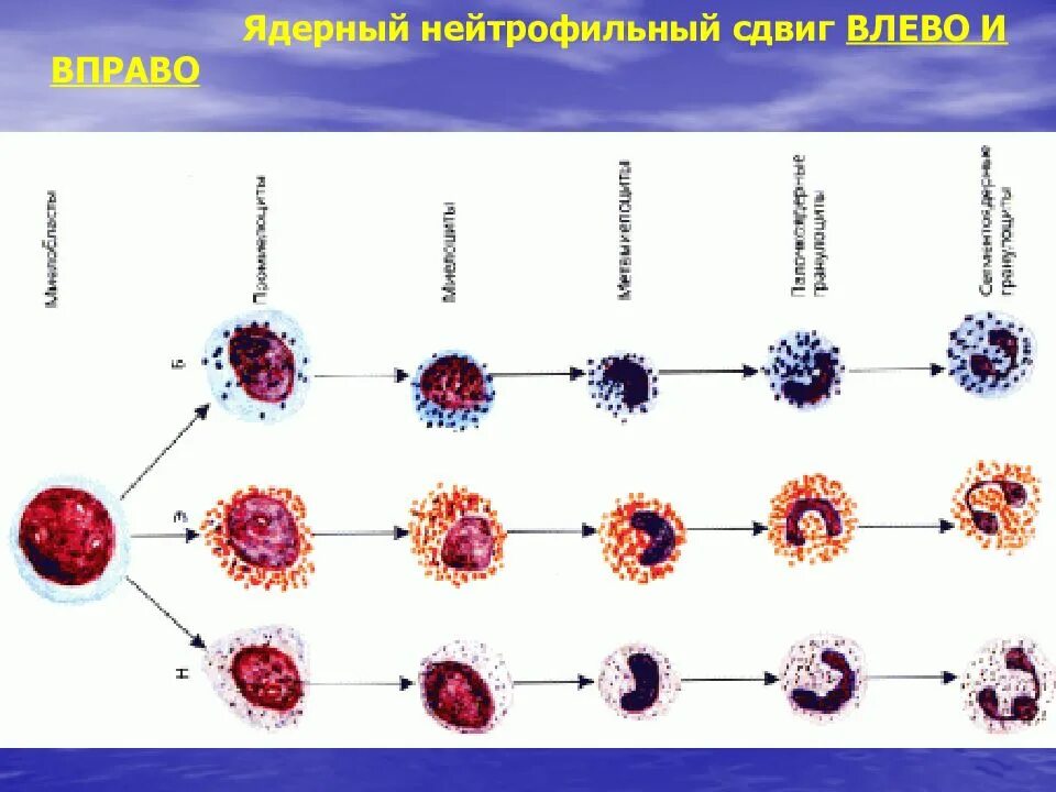 Нейтрофильный индекс. Нейтрофильный ядерный сдвиг. Ядерный нейтрофильный сдвиг влево. Ядерный сдвиг нейтрофилов вправо. «Ядерные сдвиги» нейтрофильных лейкоцитов.