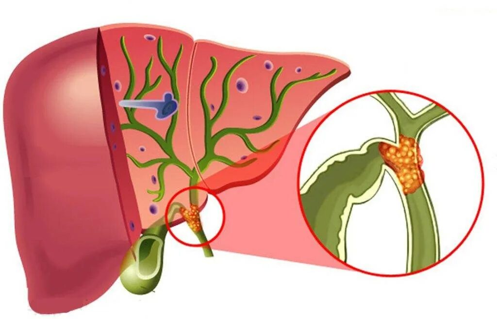 Закупорка желчевыводящих путей. Закупорка камнем желчного протока. Gallbladder желчный пузырь. Печеночная и желчная колика. Камни в протоках желчного пузыря.