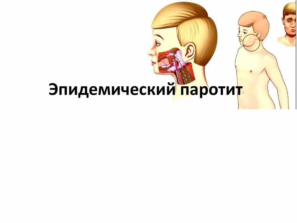 Паротит спб. Эпидемический паротит. Свинка эпидемический паротит. Острый эпидемический паротит. Эпидемиологический паротит презентация.