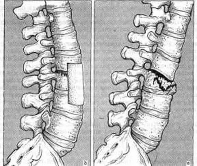 Повреждения позвоночника переломы. Компрессионный перелом th8. Компрессионный перелом тела т11 позвонка. Клиновидный компрессионный перелом позвоночника. Компрессионный перелом позвоночника th8.