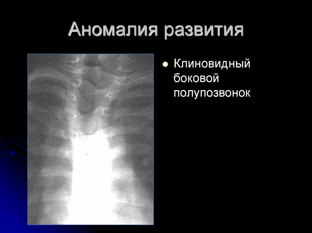 Сращение шейных позвонков рентген. Аномалия костной. Аномалия костной. Аномалии соединения костей. Аномалии развития позвонков.
