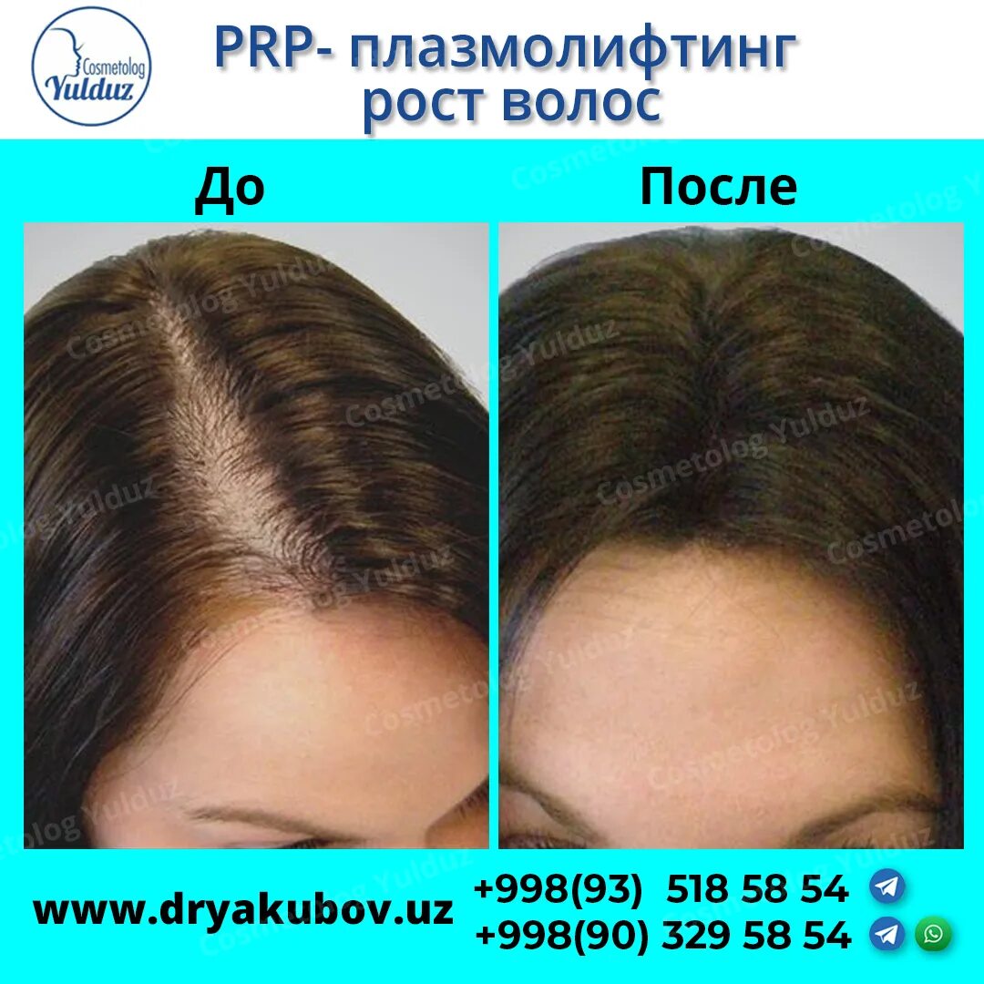 PLASMOLIFTING ДЛЯ ВОЛОС. СОВРЕМЕННО И БЕЗОПАСНО ! В клинике Красоты и Здоровья п