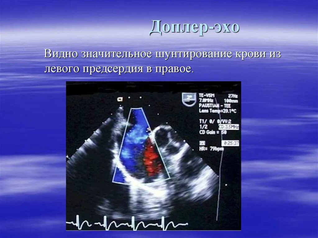 Допплер ЭХОКГ. Эхо кг допплер. Эхокардиография сердца. Допплеровское исследование сердца. Эхо кс цена