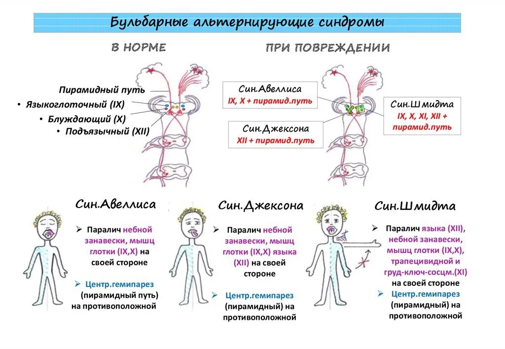 Альтернирующий синдром Авеллиса. Пирамидный гемипарез. Гемипарез на противоположной стороне. Гемипарез симптомы