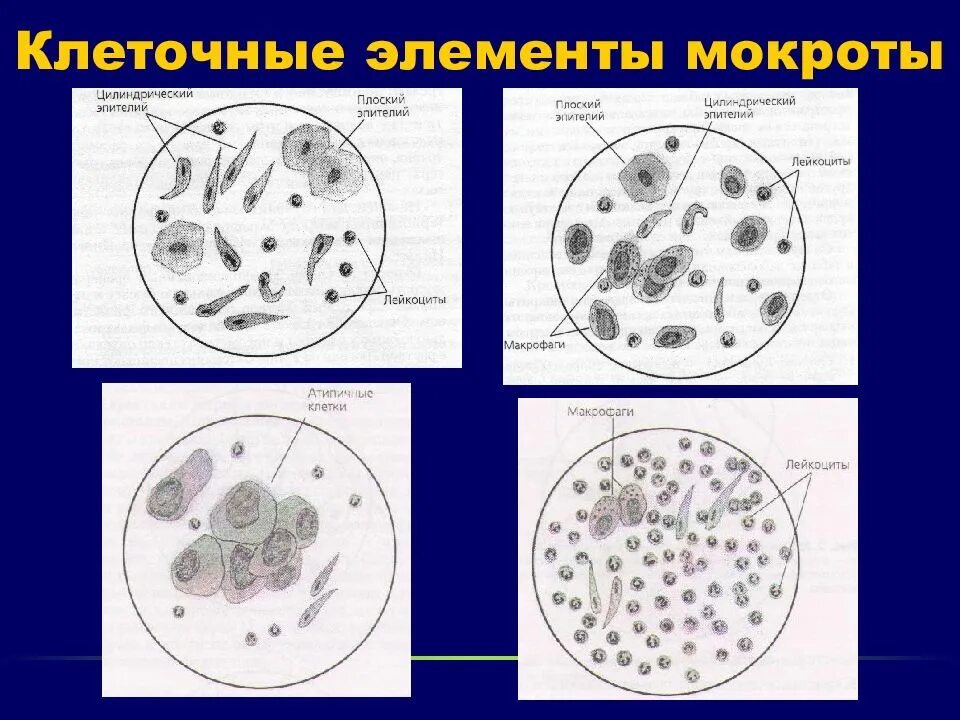 Элементы мокроты. Микроскопическое исследование нативного препарата мокроты. Клетки мокроты нативный препарат. Микроскопия мокроты атлас. Мокрота при микроскопии.