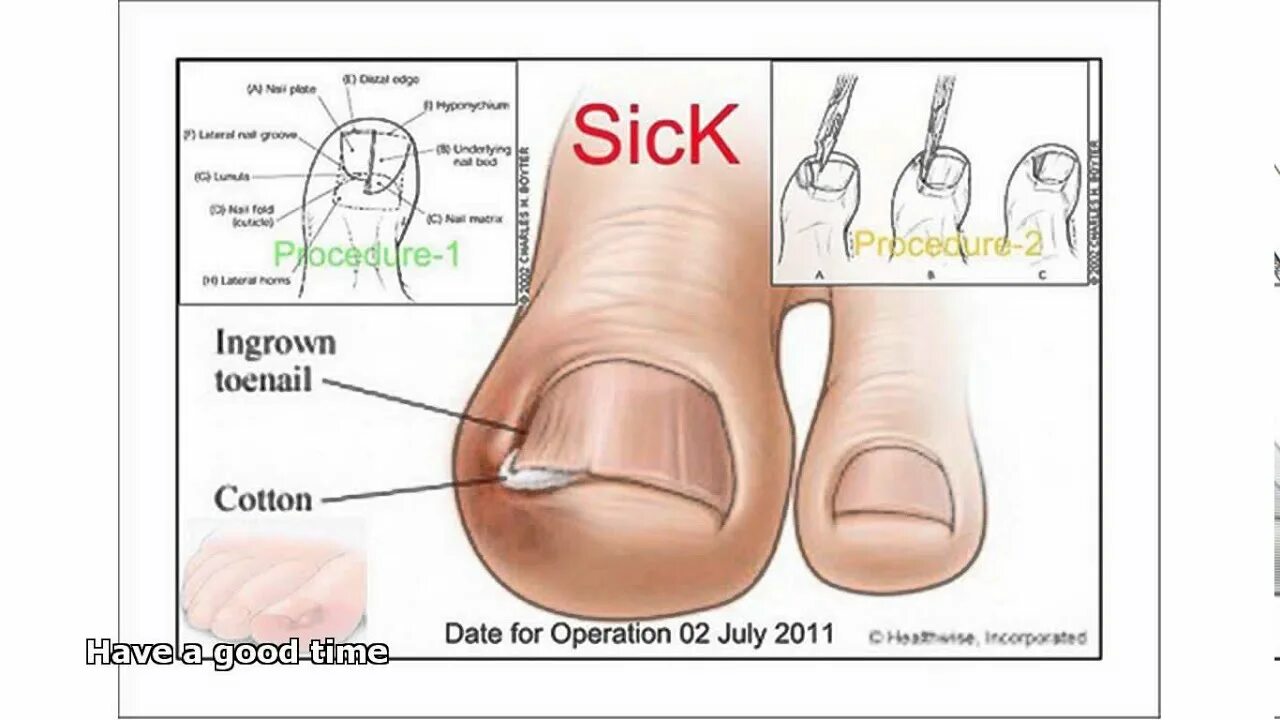 Как подстригать ноготь большого пальца ноги. Вырезание вросшего ногтя. Обработка вросшего ногтя на ноге.