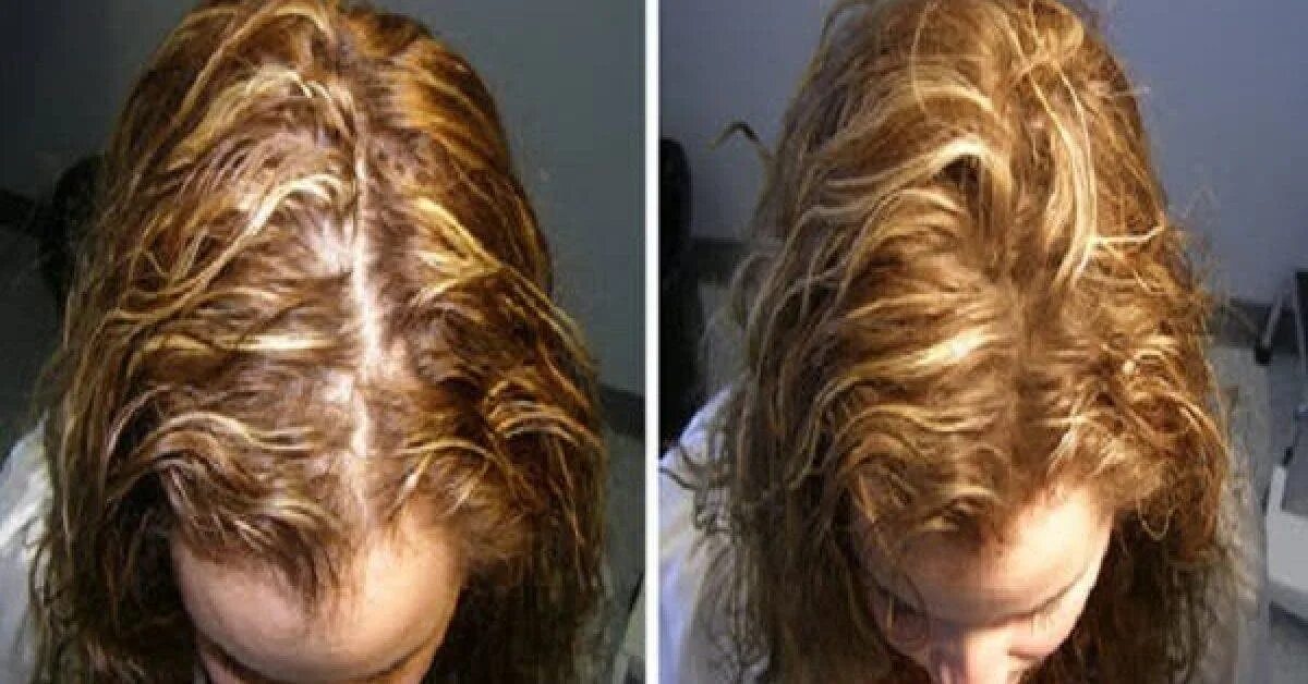 Выпадение волос после химической завивки. После хим завивки выпадают волосы. Химическая завивка при алопеции. Кератин после химической завивки.