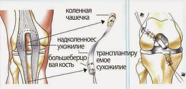 Разрыв связок ПКС коленного сустава. Разрыв связок коленного сустава ПКС операция. Реабилитация после повреждения связок коленного сустава. Имплант крестообразной связки коленного сустава. Симптомы крестообразной связки коленного сустава