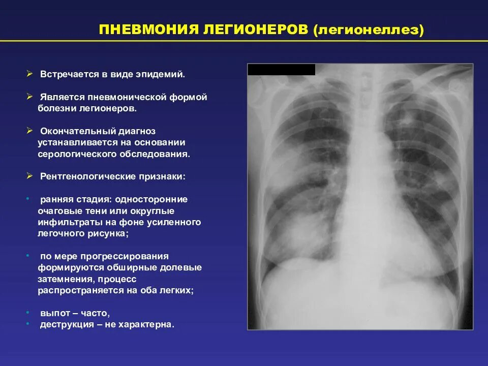 Физиологические изменения в легких. Пневмония в стадии разрешения рентген. Легионеллезная пневмония рентген. Легионеллез пневмония кт. Рентген при легионеллезной пневмонии.