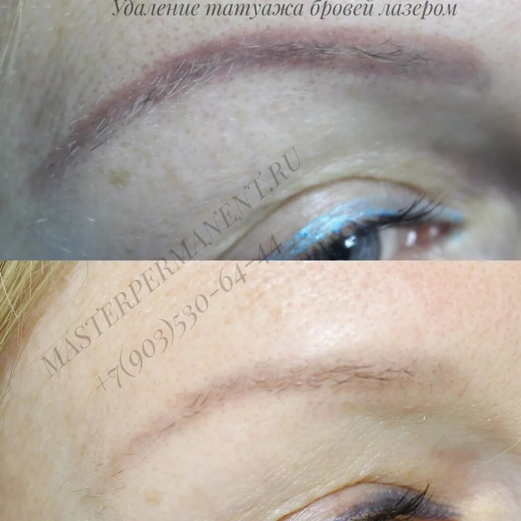 брови после лазера. удаление перманентного макияжа бровей лазером. красные брови после лазера. удаление перманента лазером брови. удаление лазером красных бровей.